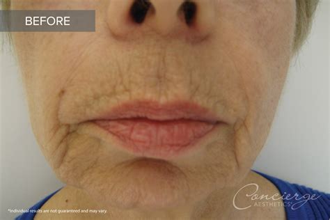 Before and After Photos - Juvederm In The Lips | Concierge Aesthetics