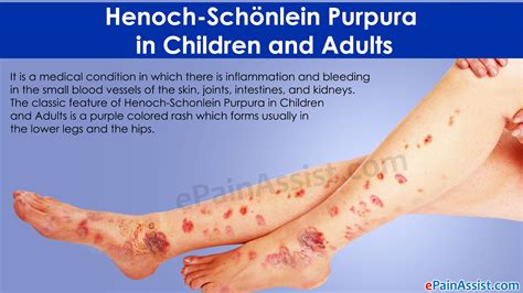 Henoch-Schonlein Purpura in Children and Adults Read: http://www ...