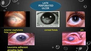 Serpiginous corneal ulcers | PPT