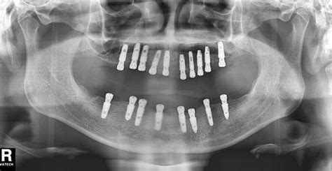 Full mouth reconstruction with Surgical Guide Technology – Hiossen Implant Canada