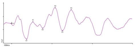 Visually Evoked Potentials (VEP) - Diagnosys LLC