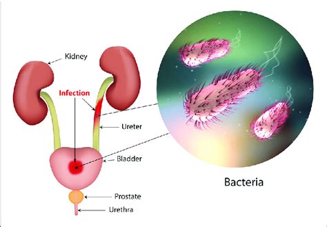 | The urinary tract and sites of infection. | Download Scientific Diagram