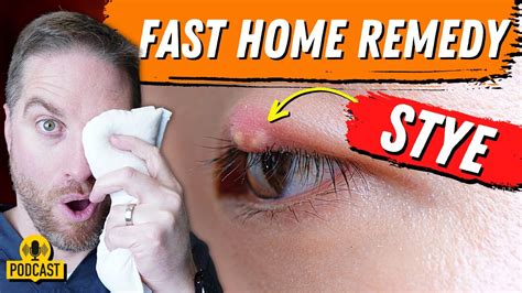 Stye Treatment Home Remedy