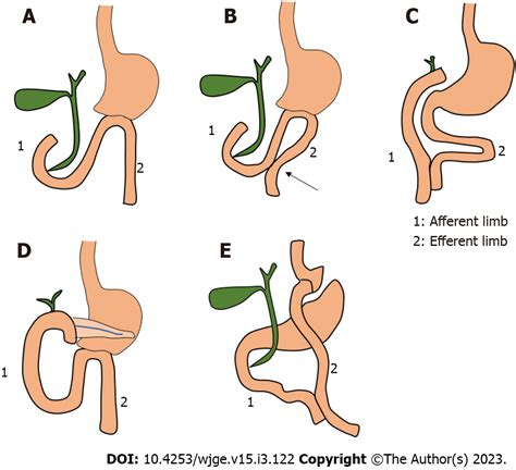 Endoscopic ultrasound guided biliary drainage in surgically altered anatomy: A comprehensive ...