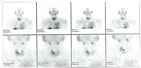 Technetium-99m sestamibi parathyroid scan. The scan shows focal area of... | Download Scientific ...