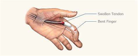 Image result for Trigger Finger | Trigger finger treatment, Trigger finger, Cranial nerves anatomy