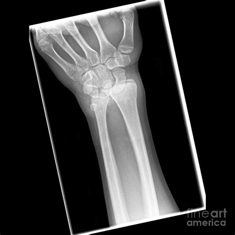 Dislocated Wrist X Ray