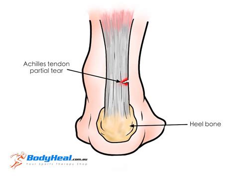 Achilles Tendon Injuries: Tendonitis, Tendinosis, Tear & Rupture ...