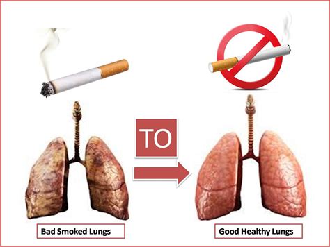 Smokers Lungs Medical Term at Holly Lopez blog