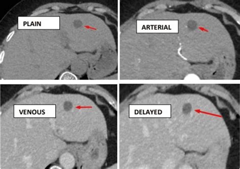 Cureus | The Role of Computed Tomography Perfusion in Various Focal ...