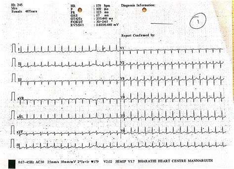 Cardiology window: PSVT