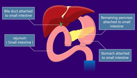 Whipple Procedure | MemorialCare