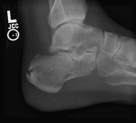 life after a calcaneus fracture surgery - Pearle Payton