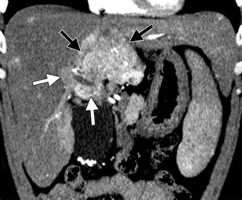 Porta Hepatis Lymph Node