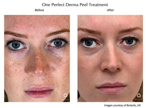 The PERFECT Derma Peel in San Diego | La Jolla Cosmetic Surgery Centre