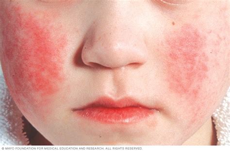 Parvovirus infection face rash - Mayo Clinic