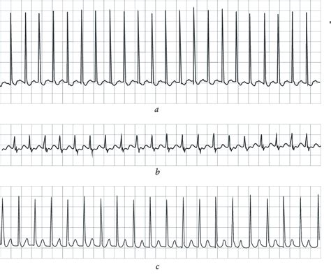 Pediatric Svt Ecg