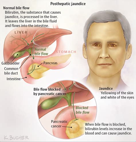 Jaundice (Hyperbilirubinemia) in Cancer | Gastrointestinal Cancer ...