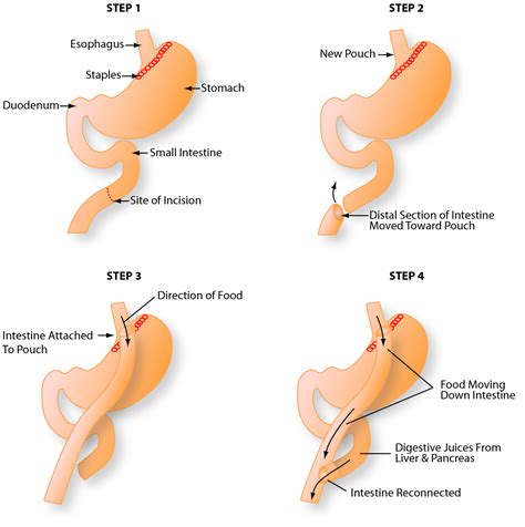 The Physical and Psychological Gastric Bypass Surgery Complications