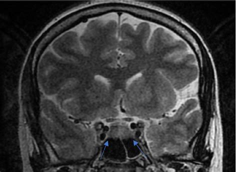 Pituitary Tumor Mri