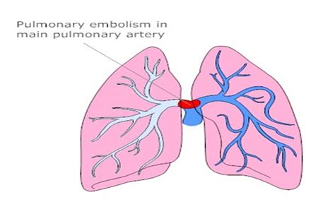 Changing definitions for massive pulmonary embolism | Dr.S.Venkatesan MD