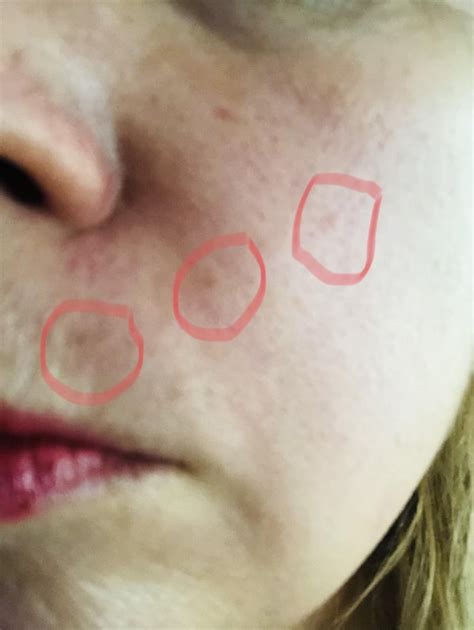 Bed bug bites on face? More info in comments. : r/Bedbugs