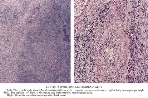 Primary Syphilis Histology