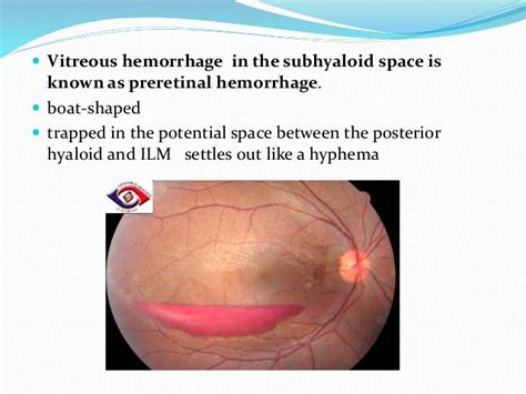 Vitreous hemorrhage