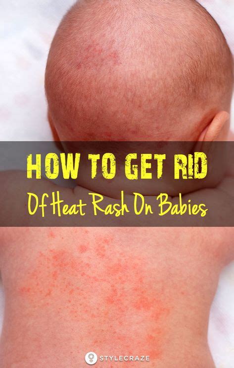 How To Get Rid Of Heat Rash On Babies | Heat rash, Baby heat rash, Heat ...