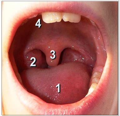 Causes of Swollen Uvula (Throat) - Symptoms, Treatment, Remedies ...