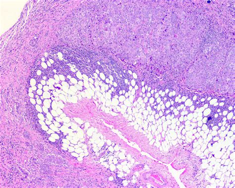 Epithelioid Mesothelioma Pathology Outlines - Goimages 411