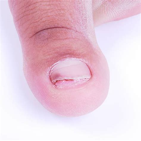 Top 60 Ingrown Nail Stock Photos, Pictures, and Images - iStock