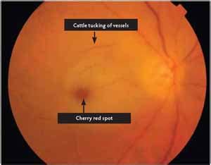 Differential DIagnosis of Cherry Red Spot - Medical Zone