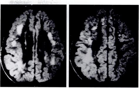 -Congenital cytomegalovirus (CMV) encephalitis. A and B, Axial MR ...