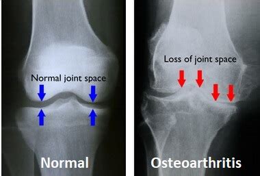 Osteoarthritis Knee Pain: Stages & Progression - Knee Pain Explained