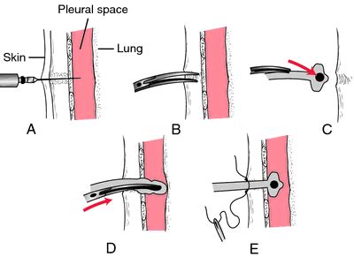 Thoracostomy | definition of thoracostomy by Medical dictionary