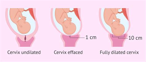 Cervical effacement and dilatation in childbirth