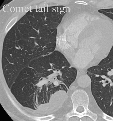 Comet tail sign Rounded atelectasis (Initially coined for tomography)