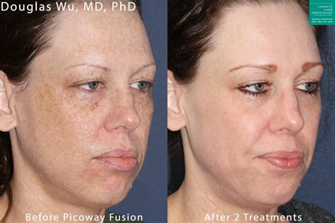 Picoway Laser Skin Treatment | San Diego, CA | CLDerm