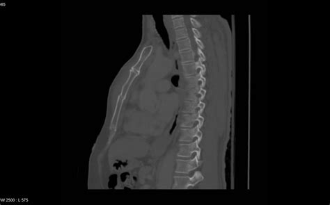 Fractured Sternum - CT Thorax (Sagittal) - radRounds Radiology Network