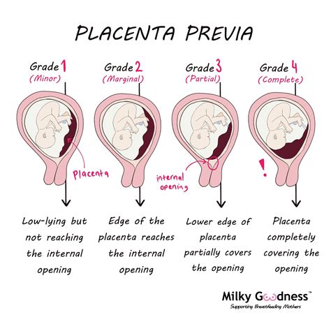 What is placenta previa? - Milky Goodness