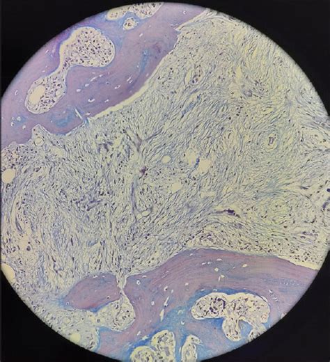 (Reticulin special stain) biopsy shows very few fat spaces with ...