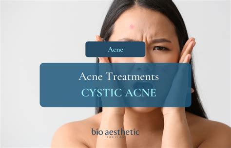 Cystic Acne : Treatment, Benefits, Price & Prevention (2024)