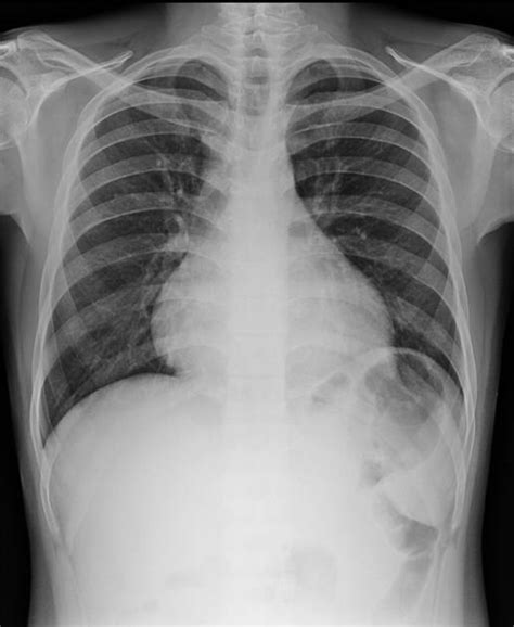 Pericardial effusion | Radiology Case | Radiopaedia.org