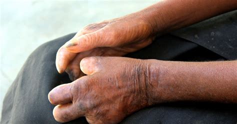 Leprosy: Why Treatment Needs To Go Beyond The Cure | HuffPost UK News