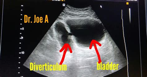 Ultrasound imaging: Urinary-bladder-Diverticulum-3D ultrasound