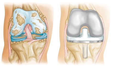 Knee Replacement Pinehurst, NC | Knee Surgery Pinehurst, NC