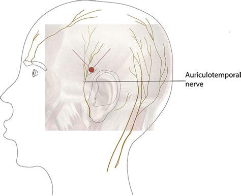 Auriculotemporal nerve block. The needle is inserted into the red dot ...