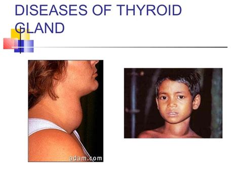 Brief introduction on disorders of thyroid gland