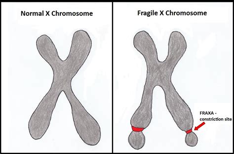 File:Fragile X Chromosome..jpg - Embryology